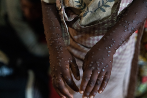 Mpox spread slows slightly in Africa